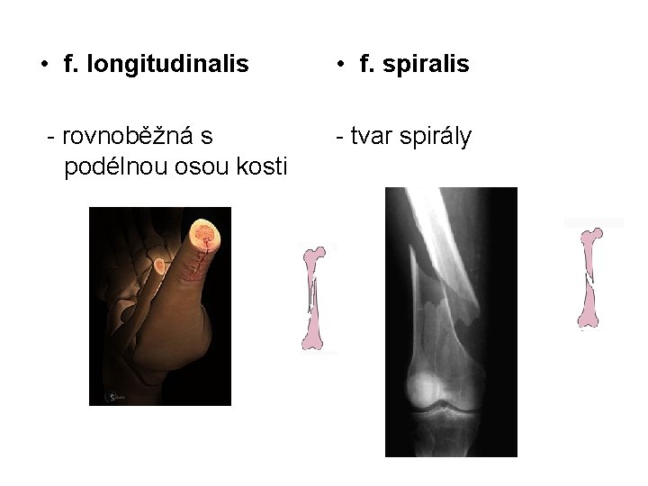  • f. longitudinalis • f. spiralis - rovnoběžná s podélnou osou kosti -