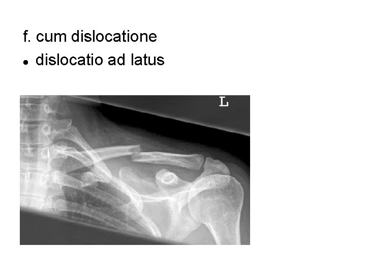 f. cum dislocatione dislocatio ad latus 