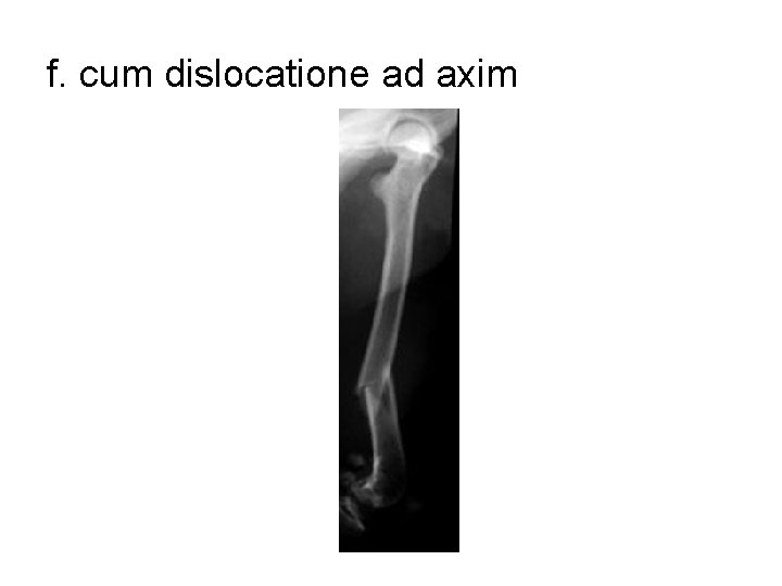 f. cum dislocatione ad axim 