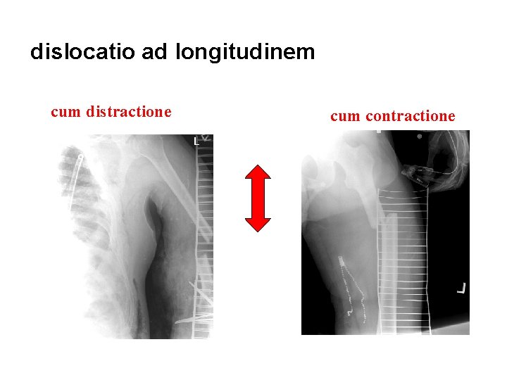 dislocatio ad longitudinem cum distractione cum contractione 