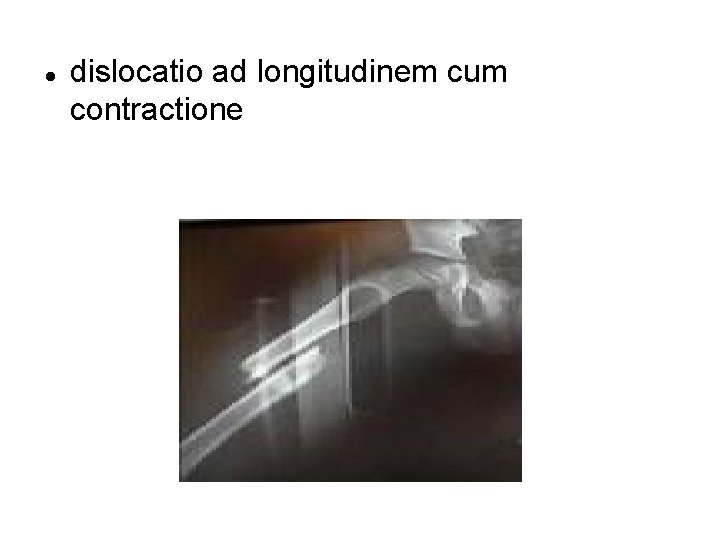  dislocatio ad longitudinem cum contractione 