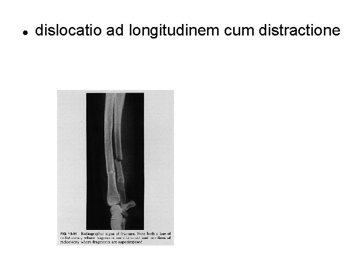  dislocatio ad longitudinem cum distractione 