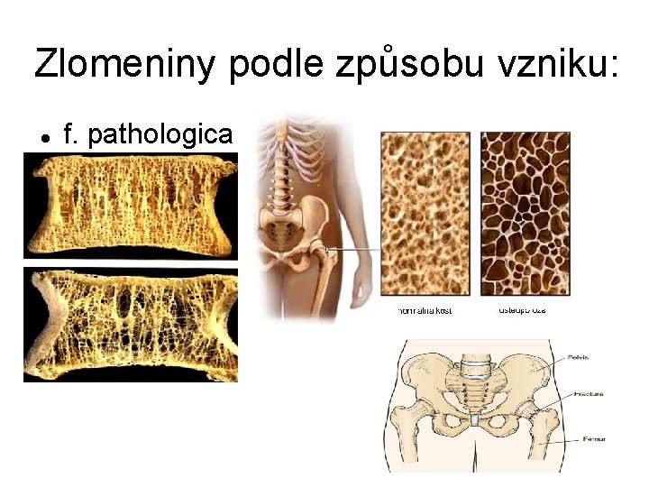 Zlomeniny podle způsobu vzniku: f. pathologica 