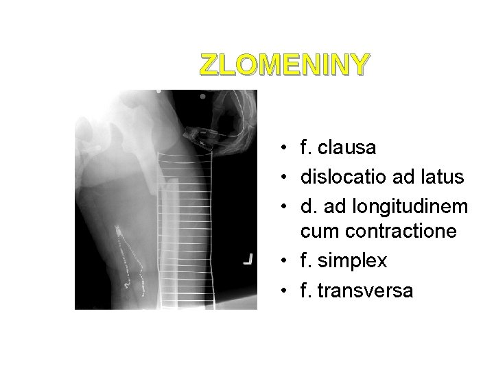 ZLOMENINY • f. clausa • dislocatio ad latus • d. ad longitudinem cum contractione