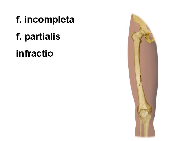 f. incompleta f. partialis infractio 