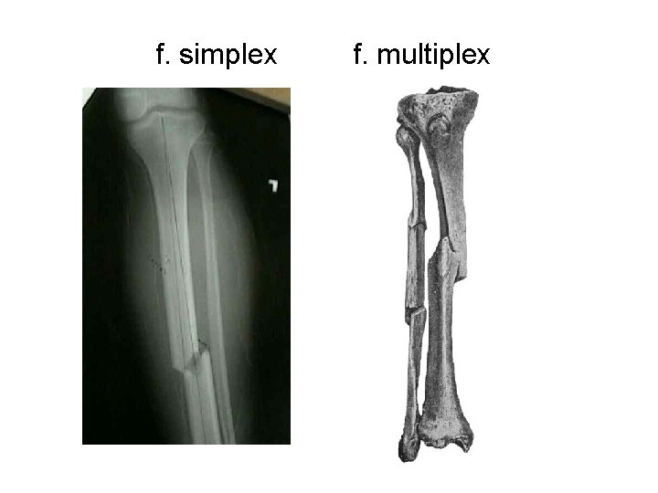 f. simplex f. multiplex 