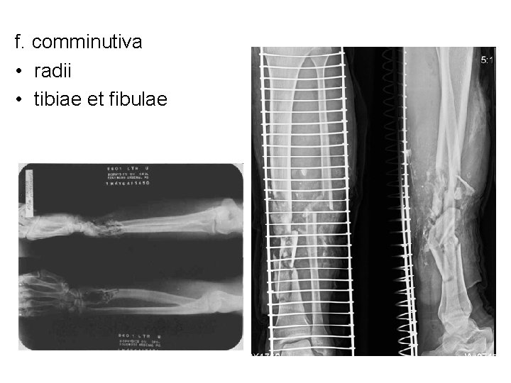 f. comminutiva • radii • tibiae et fibulae 