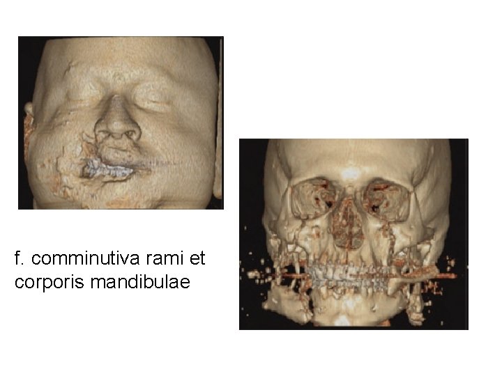f. comminutiva rami et corporis mandibulae 
