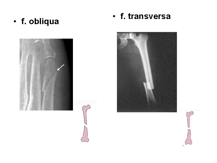  • f. obliqua • f. transversa 