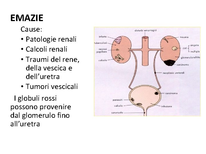 EMAZIE Cause: • Patologie renali • Calcoli renali • Traumi del rene, della vescica