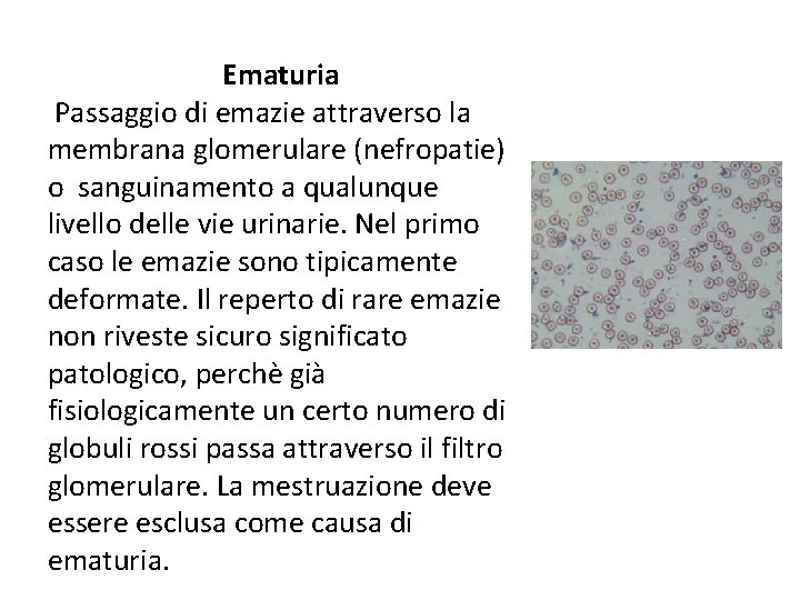 Ematuria Passaggio di emazie attraverso la membrana glomerulare (nefropatie) o sanguinamento a qualunque livello