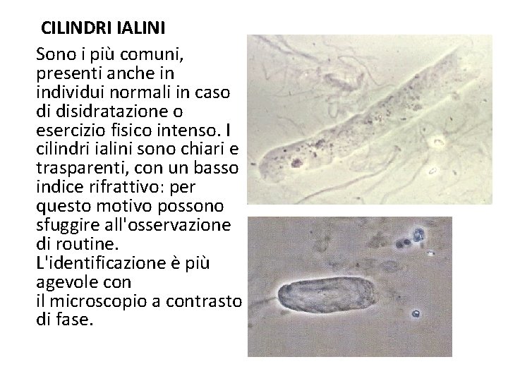  CILINDRI IALINI Sono i più comuni, presenti anche in individui normali in caso