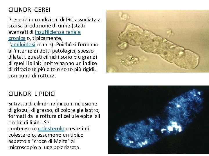 CILINDRI CEREI Presenti in condizioni di IRC associata a scarsa produzione di urine (stadi CILINDRI CEREI Presenti in condizioni di IRC associata a scarsa produzione di urine (stadi