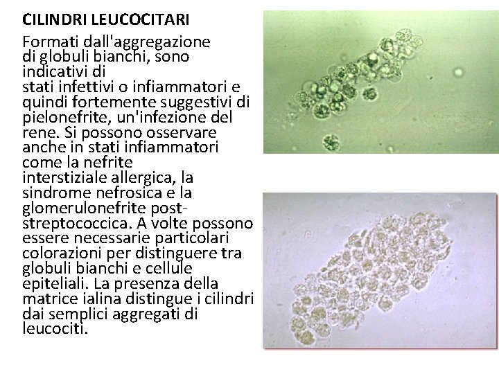 CILINDRI LEUCOCITARI Formati dall'aggregazione di globuli bianchi, sono indicativi di stati infettivi o infiammatori