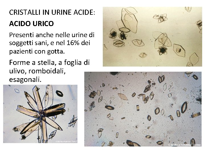 CRISTALLI IN URINE ACIDE: ACIDO URICO Presenti anche nelle urine di soggetti sani, e