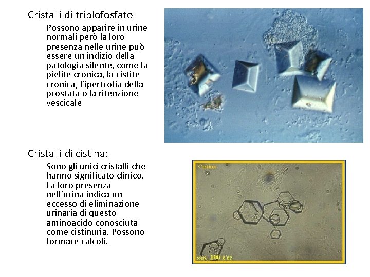 Cristalli di triplofosfato Possono apparire in urine normali però la loro presenza nelle urine