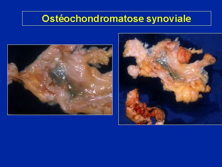 Ostéochondromatose synoviale 