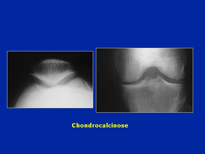 Chondrocalcinose 