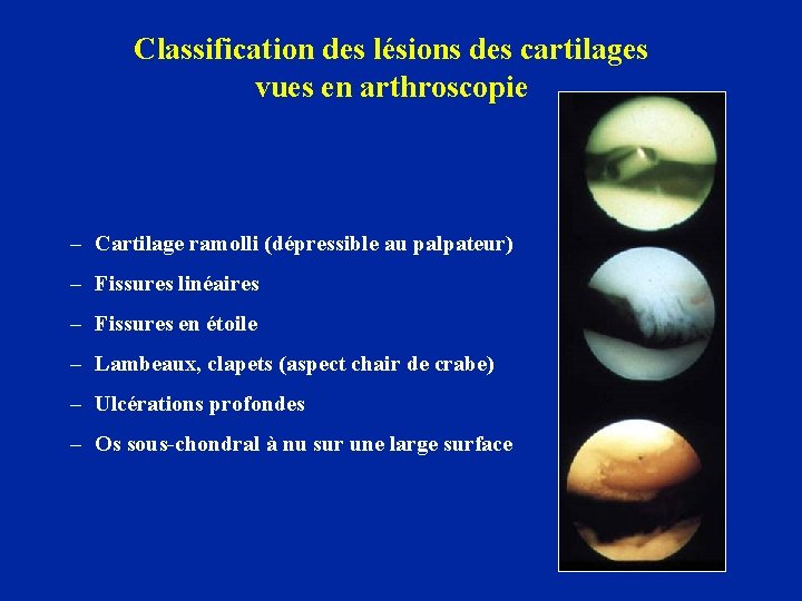 Classification des lésions des cartilages vues en arthroscopie – Cartilage ramolli (dépressible au palpateur)