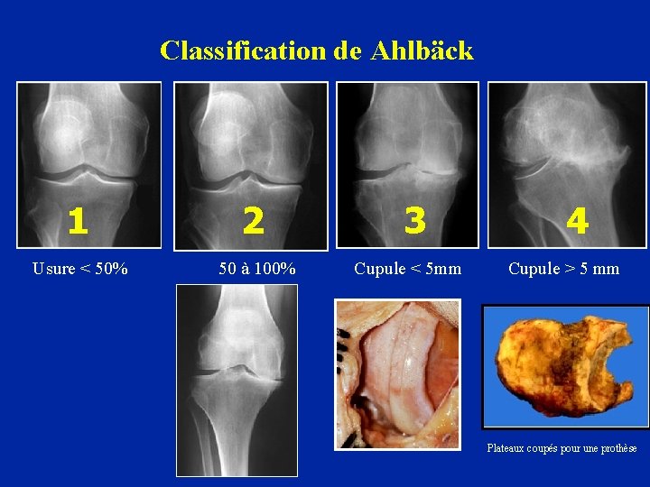 Classification de Ahlbäck 1 2 3 4 Usure < 50% 50 à 100% Cupule