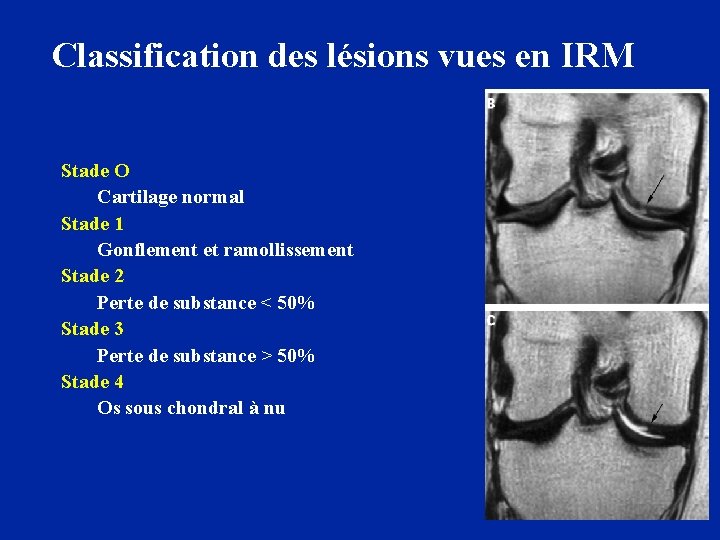 Classification des lésions vues en IRM Stade O Cartilage normal Stade 1 Gonflement et