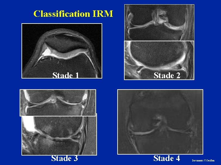 Classification IRM Stade 1 Stade 2 Stade 3 Stade 4 Documents Y Carillon 