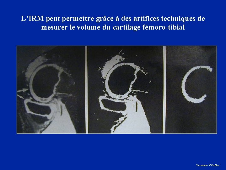 L’IRM peut permettre grâce à des artifices techniques de mesurer le volume du cartilage