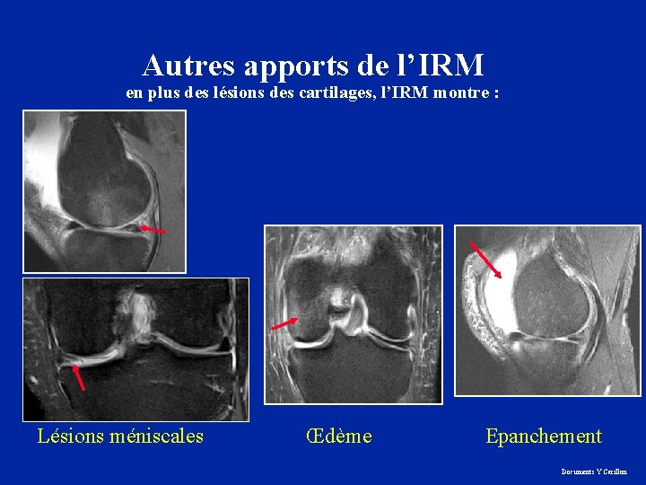 Autres apports de l’IRM en plus des lésions des cartilages, l’IRM montre : Lésions