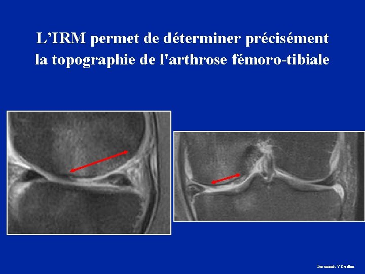 L’IRM permet de déterminer précisément la topographie de l'arthrose fémoro-tibiale Documents Y Carillon 