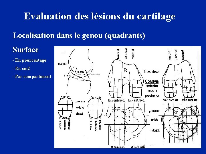 Evaluation des lésions du cartilage Localisation dans le genou (quadrants) Surface - En pourcentage