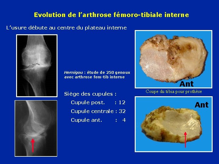 Evolution de l’arthrose fémoro-tibiale interne L’usure débute au centre du plateau interne Hernigou :