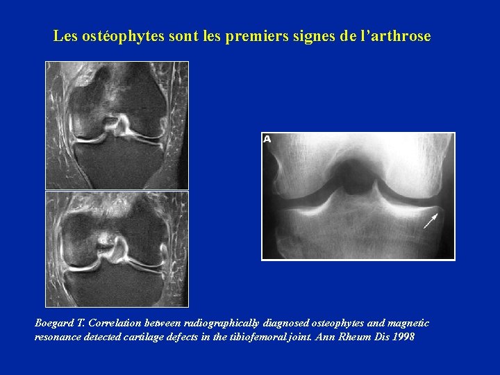 Les ostéophytes sont les premiers signes de l’arthrose Boegard T. Correlation between radiographically diagnosed