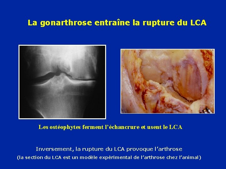 La gonarthrose entraîne la rupture du LCA Les ostéophytes ferment l’échancrure et usent le