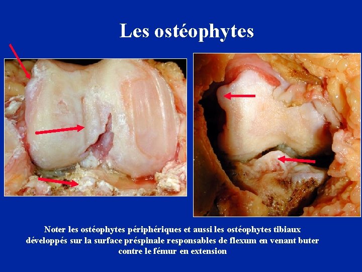 Les ostéophytes Noter les ostéophytes périphériques et aussi les ostéophytes tibiaux développés sur la