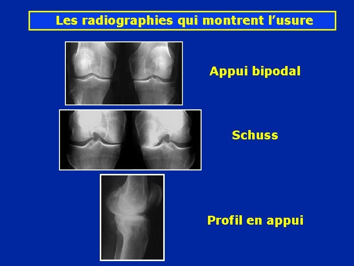 Les radiographies qui montrent l’usure Appui bipodal Schuss Profil en appui 