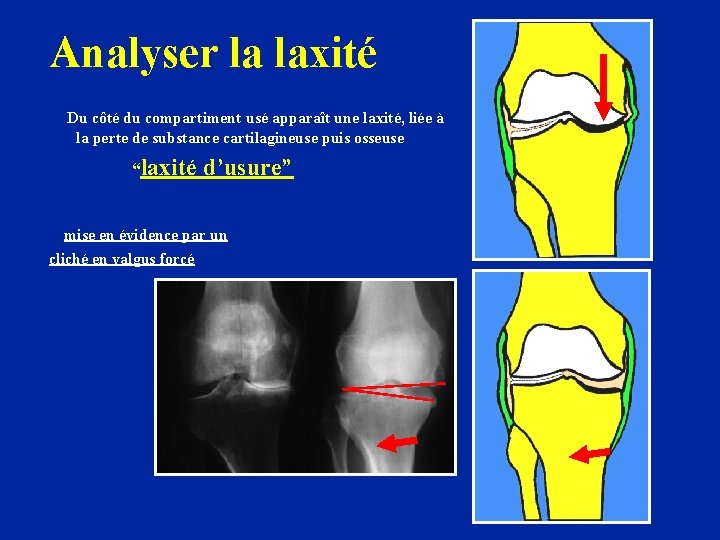 Analyser la laxité Du côté du compartiment usé apparaît une laxité, liée à la