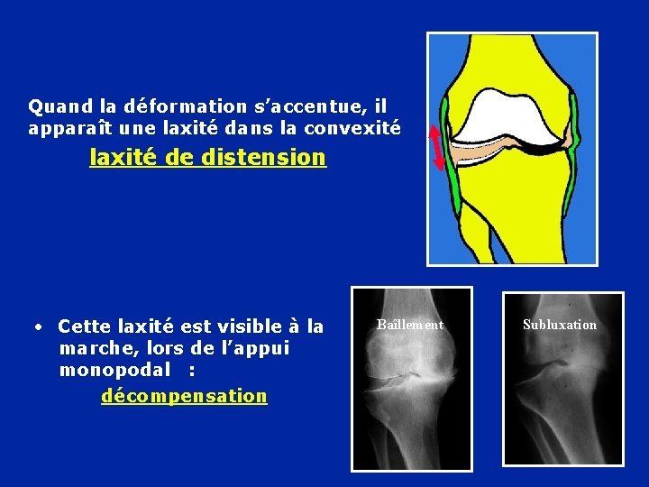 Quand la déformation s’accentue, il apparaît une laxité dans la convexité laxité de distension