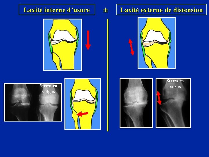 Laxité interne d’usure Stress en valgus ± Laxité externe de distension Stress en varus