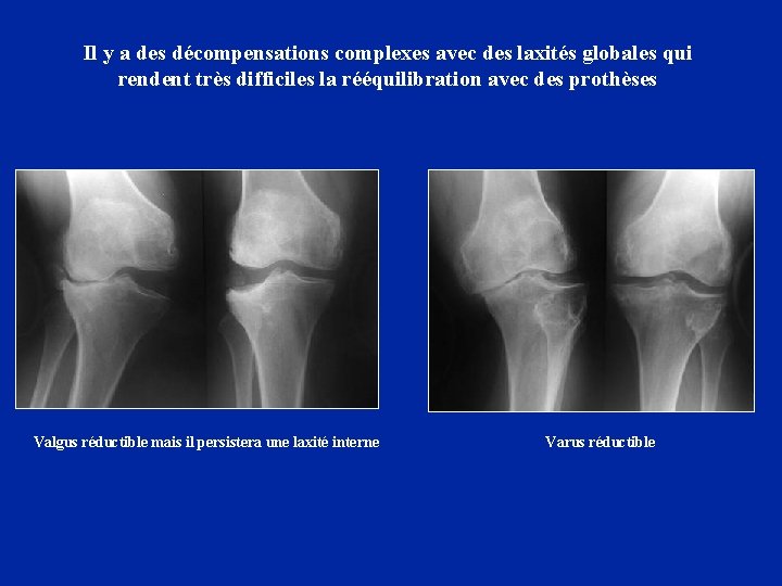 Il y a des décompensations complexes avec des laxités globales qui rendent très difficiles