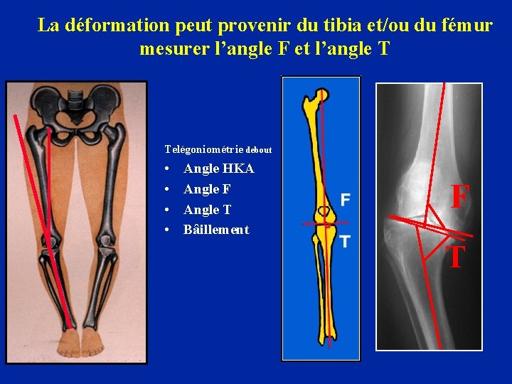 La déformation peut provenir du tibia et/ou du fémur mesurer l’angle F et l’angle