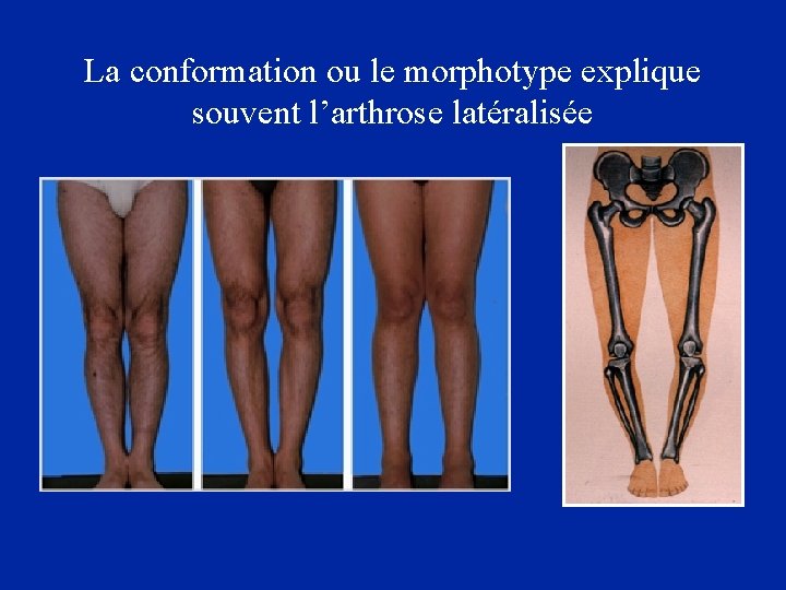 La conformation ou le morphotype explique souvent l’arthrose latéralisée 