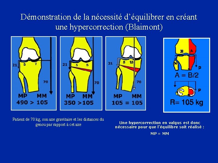 Démonstration de la nécessité d’équilibrer en créant une hypercorrection (Blaimont) Patient de 70 kg,