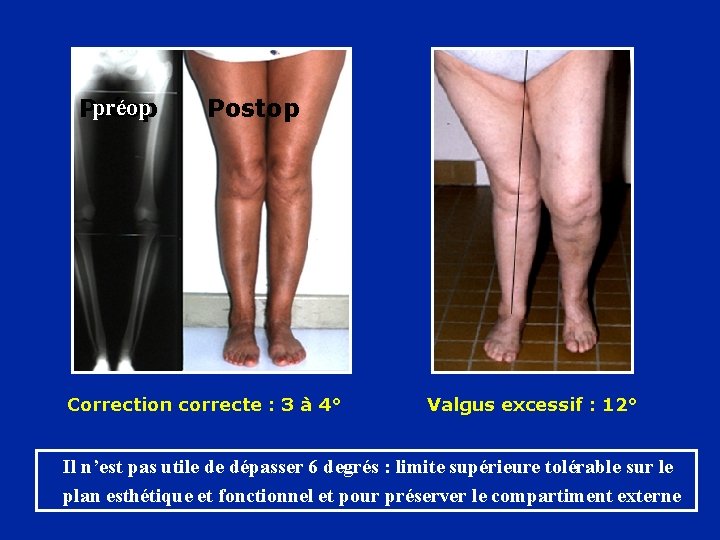 préop Postop Correction correcte : 3 à 4° Valgus excessif : 12° Il n’est