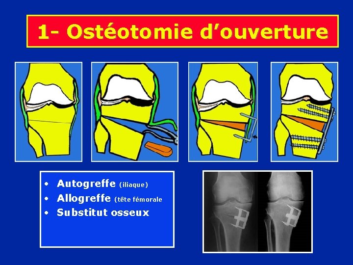 1 - Ostéotomie d’ouverture • Autogreffe (iliaque) • Allogreffe (tête fémorale • Substitut osseux