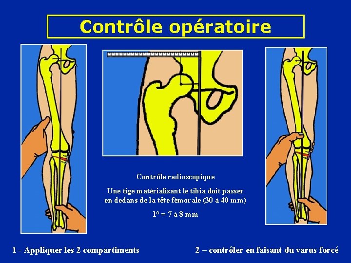 Contrôle opératoire Contrôle radioscopique Une tige matérialisant le tibia doit passer en dedans de