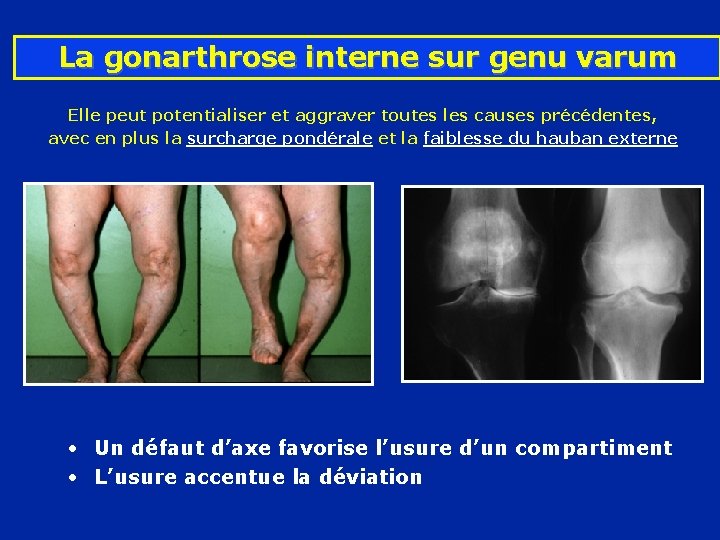 La gonarthrose interne sur genu varum Elle peut potentialiser et aggraver toutes les causes