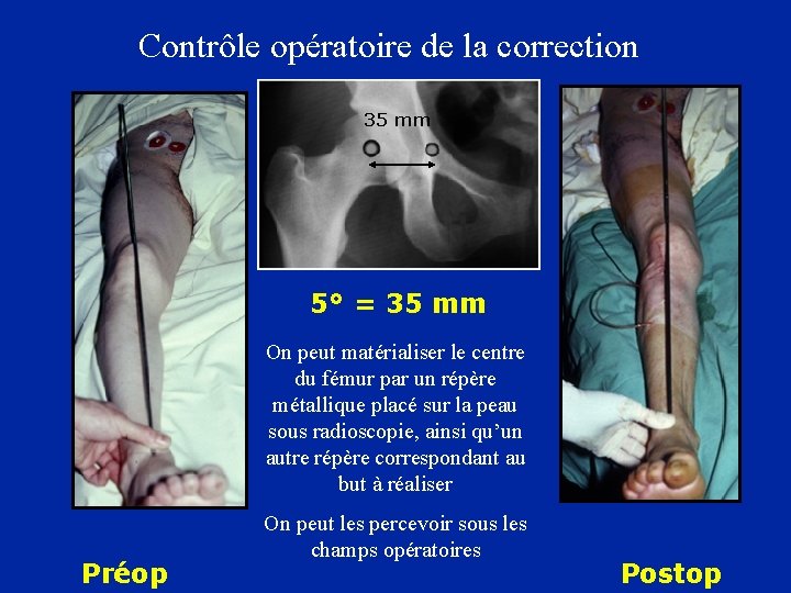 Contrôle opératoire de la correction 35 mm 5° = 35 mm On peut matérialiser