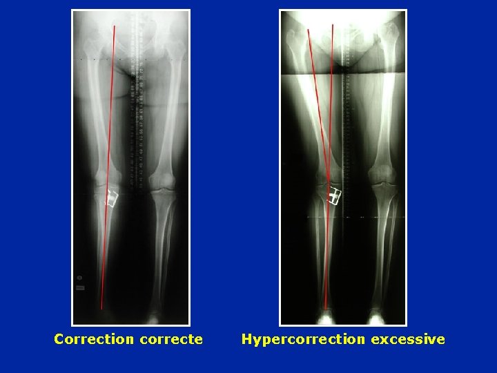 Correction correcte Hypercorrection excessive 