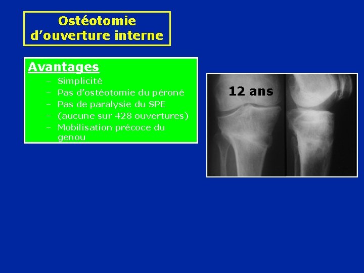 Ostéotomie d’ouverture interne Avantages – – – Simplicité Pas d’ostéotomie du péroné Pas de