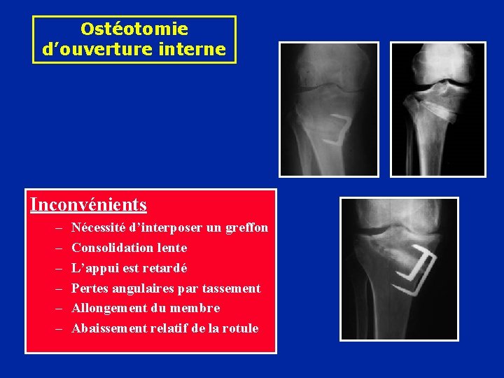 Ostéotomie d’ouverture interne Inconvénients – – – Nécessité d’interposer un greffon Consolidation lente L’appui